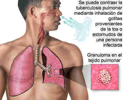 Tuberculosis Causas, Prevencion y Tratamiento de la Tuberculosis – BIOGRAFÍAS e HISTORIA UNIVERSAL,ARGENTINA y de la CIENCIA