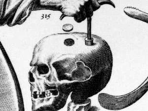 Historia de las Cirugías de Cerebro